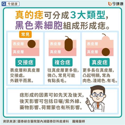 內痣是什麼|是痣or皮膚癌？醫「1張圖秒對照」 長這2部位最危險